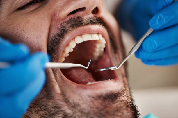 Best Dental Abscess Treatment in West Sacramento, CA